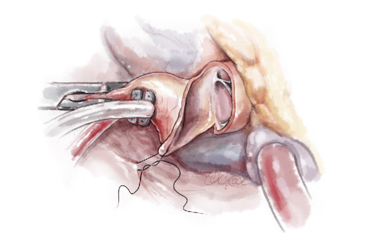 Septal Myectomy In Delhi | HOCM Surgery In India | Cardiologist/ Heart surgeon in Delhi